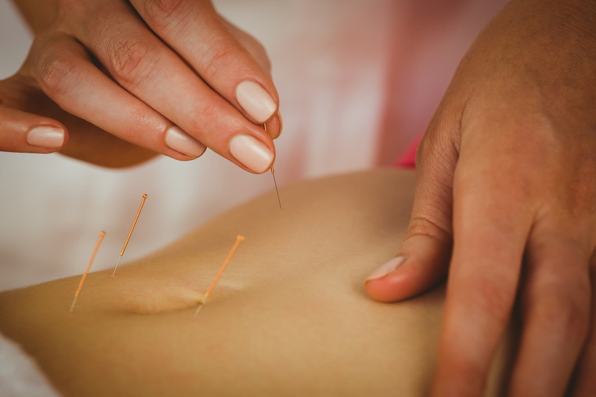 Praxis Morschek Akupunkturbehandlung
