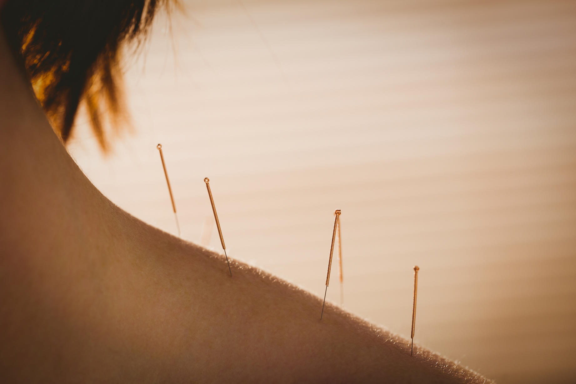 Akupunktur Frau